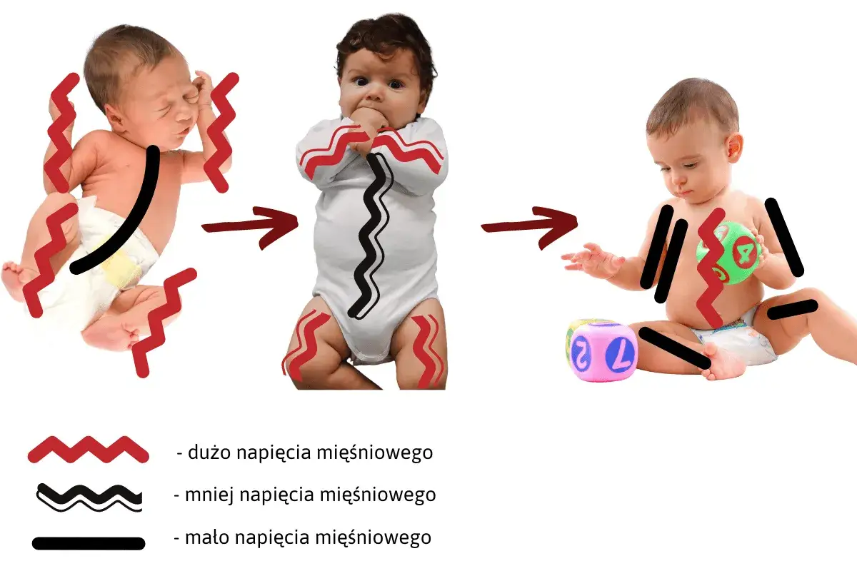 Niemowlę z zaburzeniami napięcia mięśniowego, asymetria ułożeniowa niemowlaka